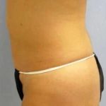 Smartlipo Vaser Lipo Before & After Patient #636