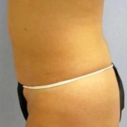 Smartlipo Vaser Lipo Before & After Patient #636
