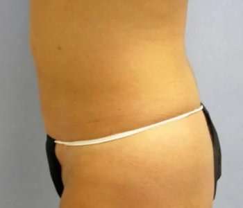 Smartlipo Vaser Lipo Before & After Patient #636