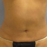 Smartlipo Vaser Lipo Before & After Patient #639