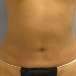 Smartlipo Vaser Lipo Before & After Patient #639