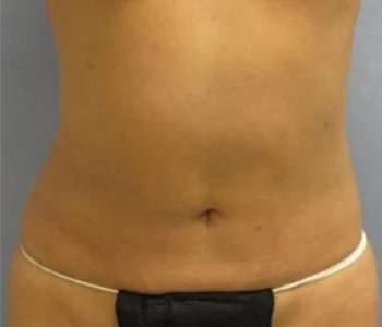Smartlipo Vaser Lipo Before & After Patient #639