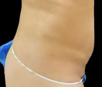 Smartlipo Vaser Lipo Before & After Patient #642