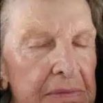 Fractional CO2 Laser Before & After Patient #122