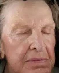 Fractional CO2 Laser Before & After Patient #122