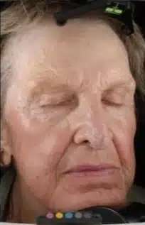 Fractional CO2 Laser Before & After Patient #122