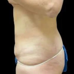 Smartlipo Vaser Lipo Before & After Patient #645