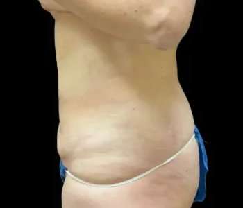 Smartlipo Vaser Lipo Before & After Patient #645