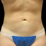 Smartlipo Vaser Lipo Before & After Patient #648
