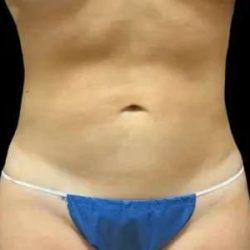 Smartlipo Vaser Lipo Before & After Patient #648
