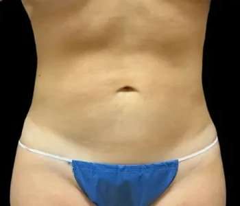 Smartlipo Vaser Lipo Before & After Patient #648