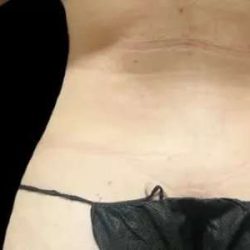 Smartlipo Vaser Lipo Before & After Patient #651