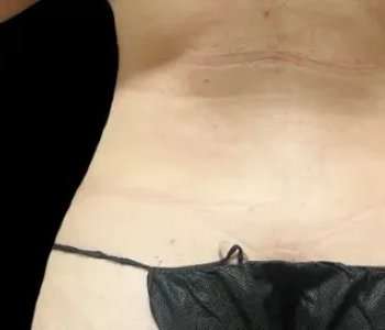 Smartlipo Vaser Lipo Before & After Patient #651