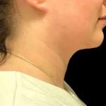 Smartlipo Vaser Lipo Before & After Patient #654