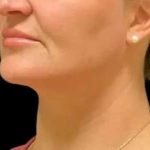 Smartlipo Vaser Lipo Before & After Patient #657