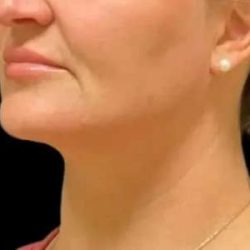Smartlipo Vaser Lipo Before & After Patient #657
