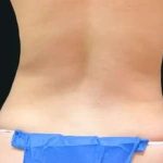 Smartlipo Vaser Lipo Before & After Patient #663