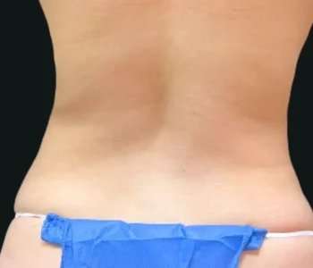 Smartlipo Vaser Lipo Before & After Patient #663