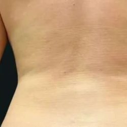 Smartlipo Vaser Lipo Before & After Patient #666