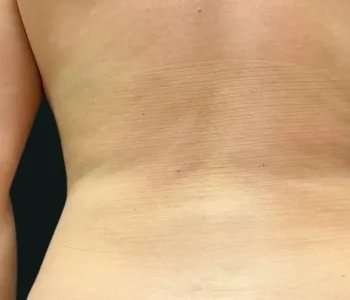 Smartlipo Vaser Lipo Before & After Patient #666