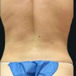 Smartlipo Vaser Lipo Before & After Patient #669