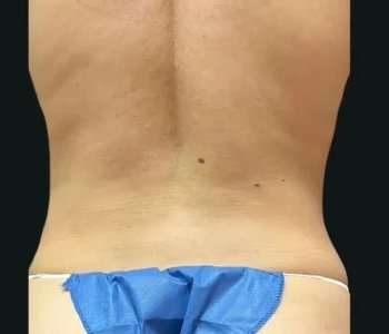 Smartlipo Vaser Lipo Before & After Patient #669