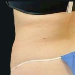 Smartlipo Vaser Lipo Before & After Patient #672