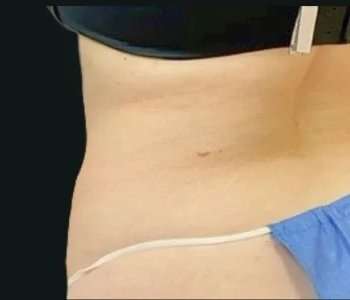 Smartlipo Vaser Lipo Before & After Patient #672