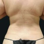 Smartlipo Vaser Lipo Before & After Patient #675