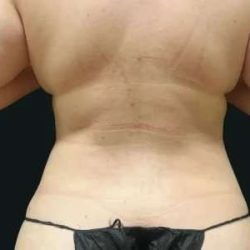 Smartlipo Vaser Lipo Before & After Patient #675