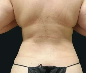 Smartlipo Vaser Lipo Before & After Patient #675