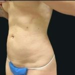 Smartlipo Vaser Lipo Before & After Patient #680