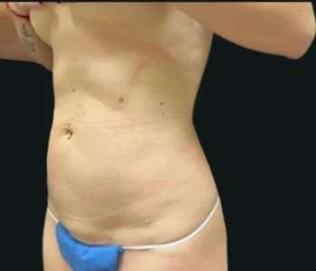 Smartlipo Vaser Lipo Before & After Patient #680