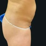 Smartlipo Vaser Lipo Before & After Patient #683