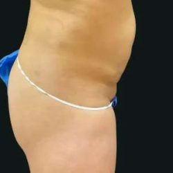 Smartlipo Vaser Lipo Before & After Patient #683