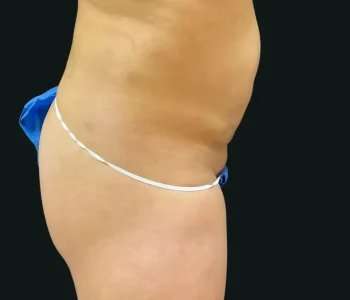 Smartlipo Vaser Lipo Before & After Patient #683