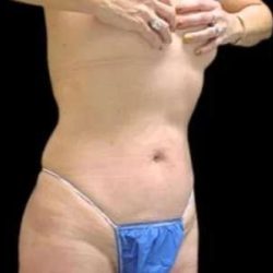 Smartlipo Vaser Lipo Before & After Patient #689