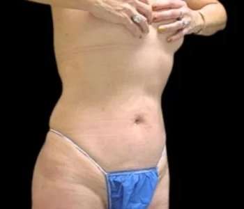 Smartlipo Vaser Lipo Before & After Patient #689