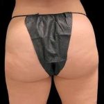 Smartlipo Vaser Lipo Before & After Patient #695