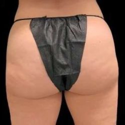 Smartlipo Vaser Lipo Before & After Patient #695