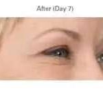 Botox Before & After Patient #701
