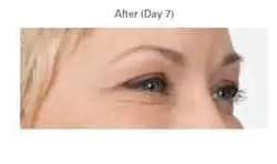 Botox Before & After Patient #701