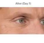Botox Before & After Patient #704