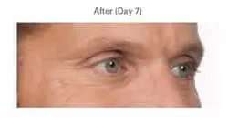 Botox Before & After Patient #704