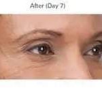 Botox Before & After Patient #707