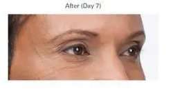 Botox Before & After Patient #707