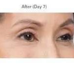 Botox Before & After Patient #710