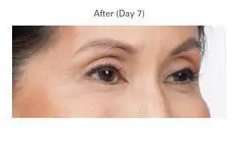 Botox Before & After Patient #710