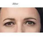 Botox Before & After Patient #713