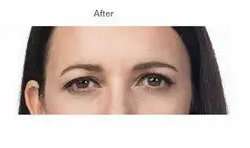 Botox Before & After Patient #713